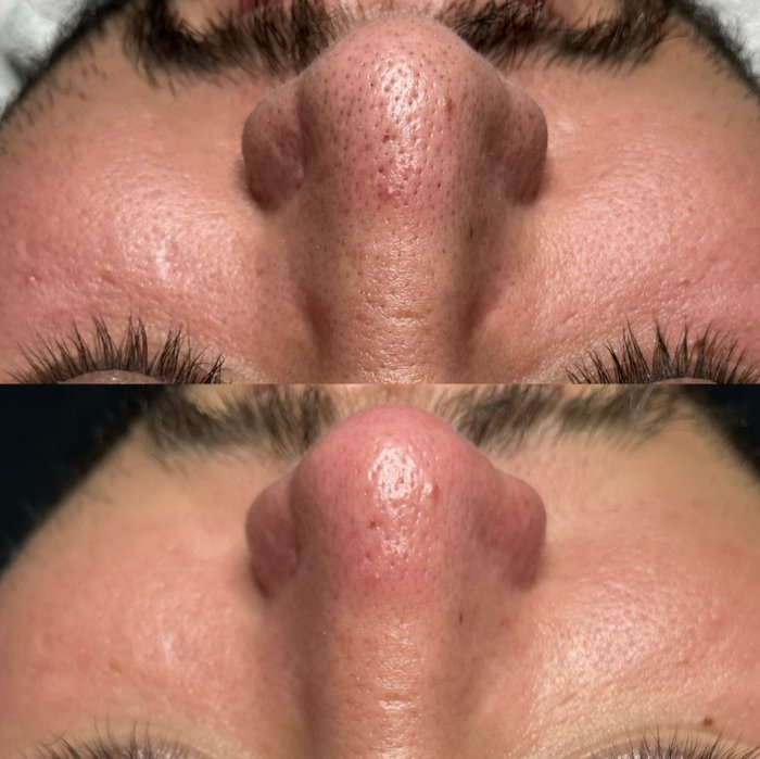 Antes e depois de uma limpeza de pele no nariz